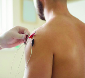 Dry Needling 2